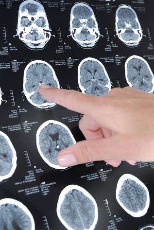 Studienergebnisse zur tiefen Hirnstimulation lassen Hoffnung für schwer behandelbare Depression aufkommen Depressionen Hirnstimulation
